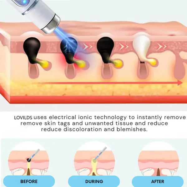 Lovilds™ Laser Pen – Safe, Painless Spot & Tag Removal