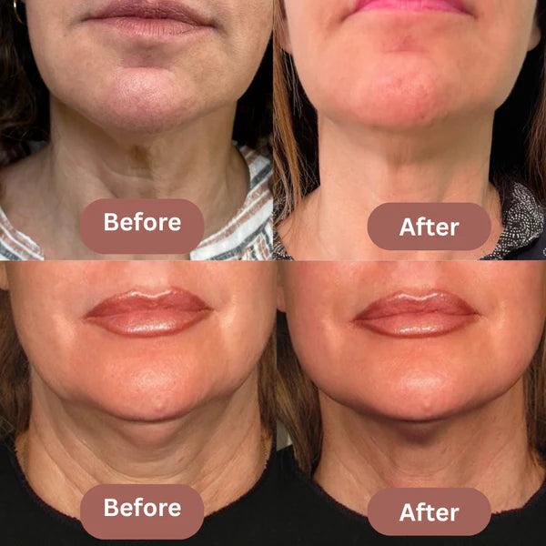 Eleve™ Lift & Sculpt Face Shaper – Effortless Jawline Definition, Day or Night