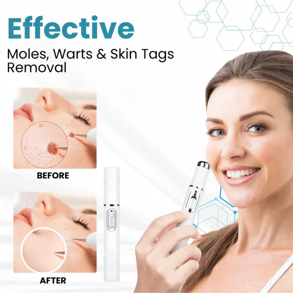 Lovilds™ Laser Pen – Safe, Painless Spot & Tag Removal