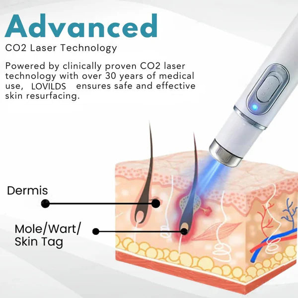 Lovilds™ Laser Pen – Safe, Painless Spot & Tag Removal