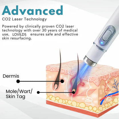 Lovilds™ Laser Pen – Safe, Painless Spot & Tag Removal
